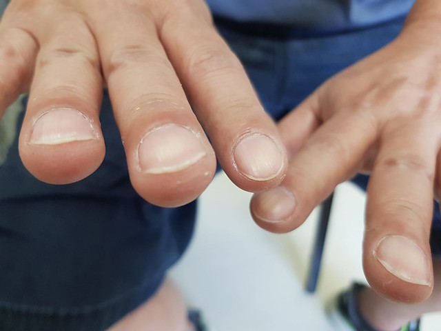 如果早上经常出现手指关节红肿痛的问题,可能是「类风湿性关节炎」在