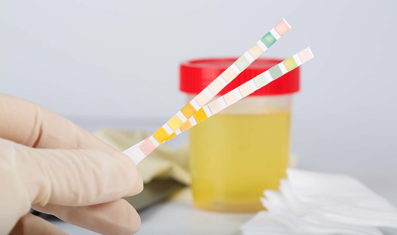 尿黄又混浊?当心这4 种疾病找上身